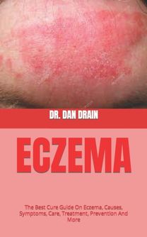 Eczema